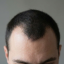 Male hair loss image generated by Gemini AI