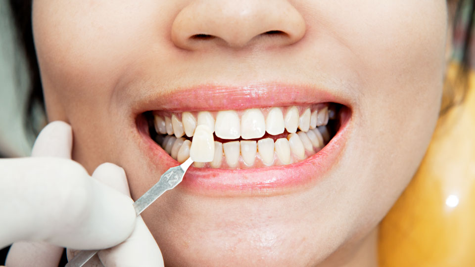 Dental veneer treatment