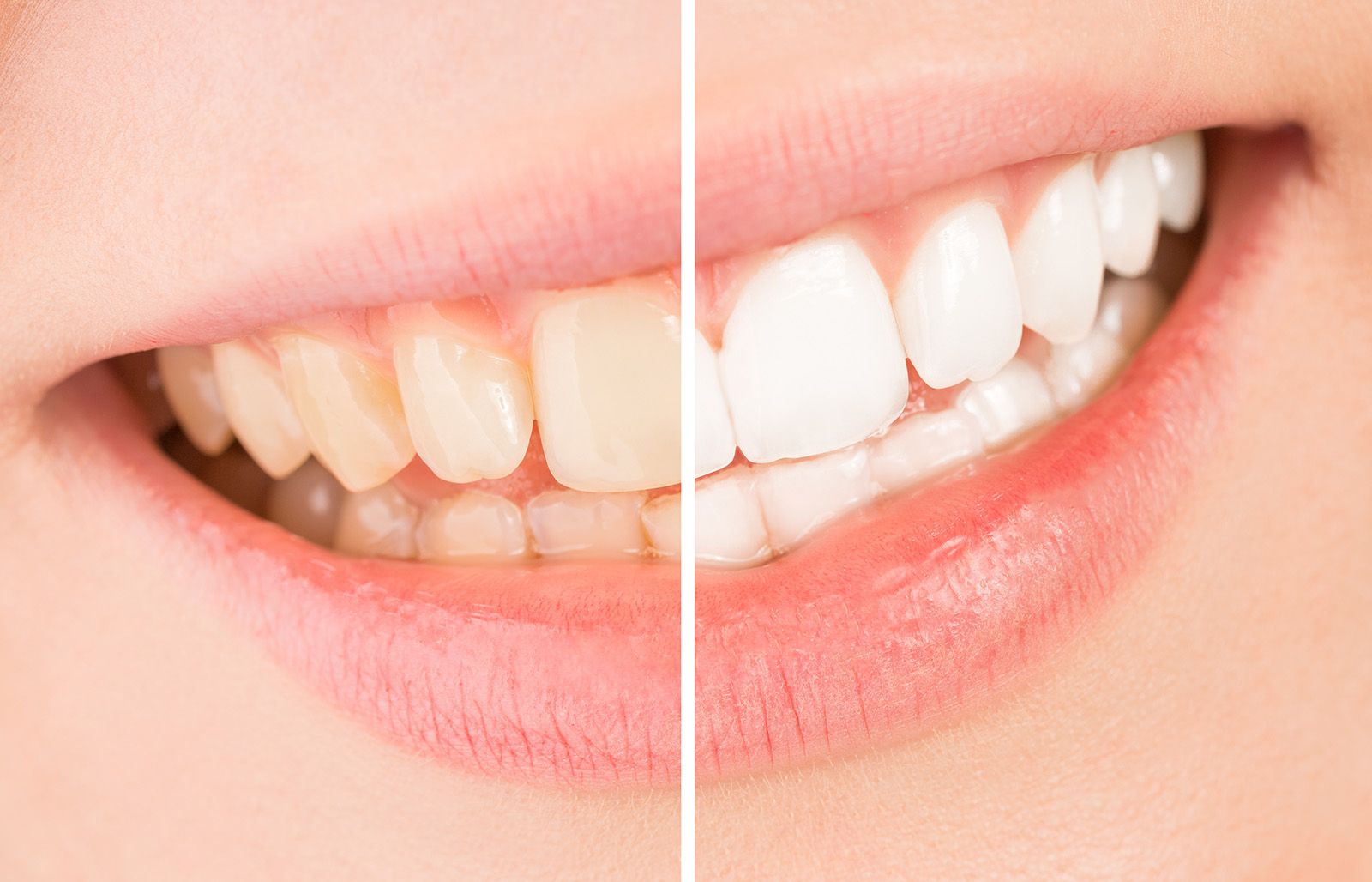 Teeth whitening process