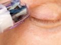 UPPER EYELID