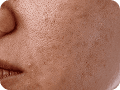 Microneedling