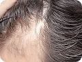 Pigmentation