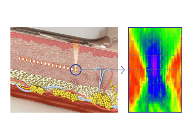 Lift, Tighten, and Contour with Micro & Macro Focused ultrasound