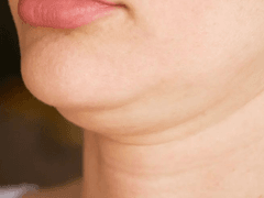Double chin 