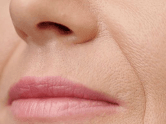 Nasolabial folds