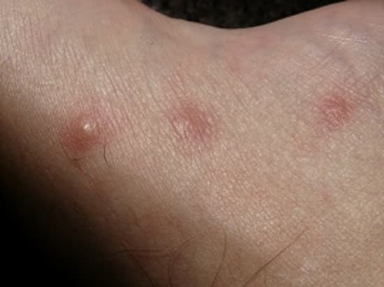 Nachweis von Histamin durch Graphen-Sensoren
