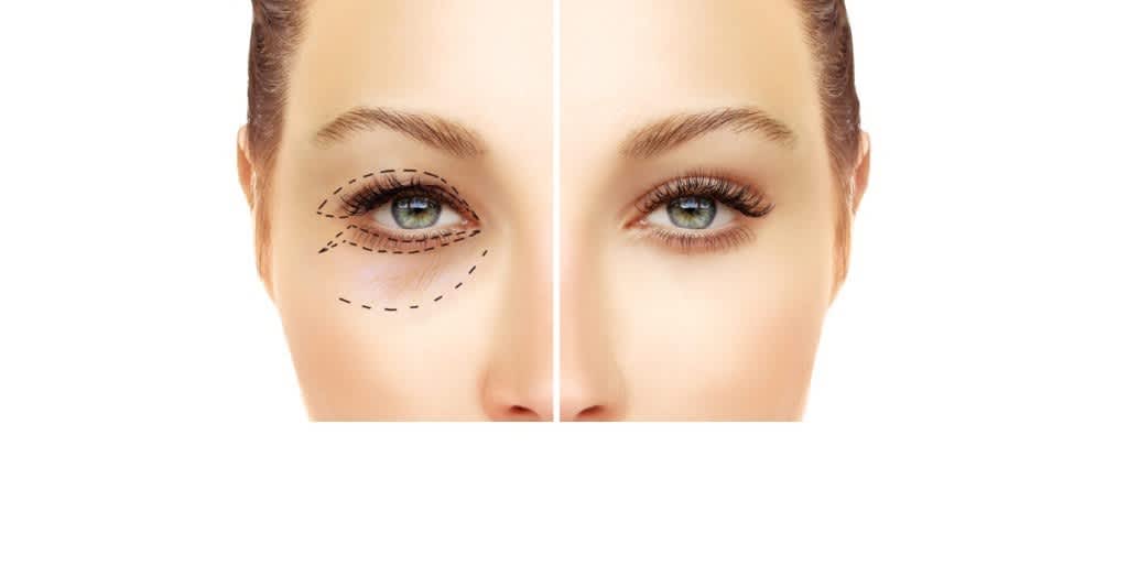 Blepharoplasty eyelid surgery result