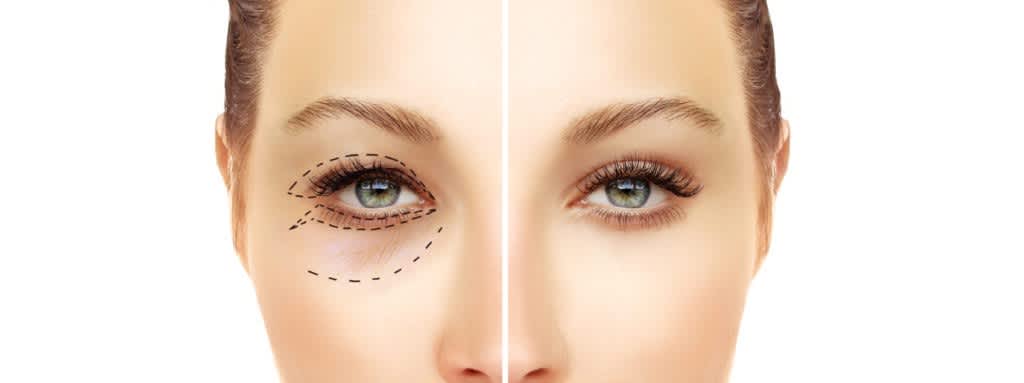 Blepharoplasty before and after