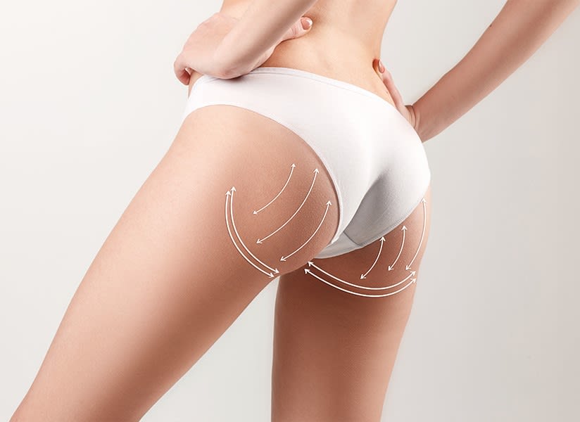 Butt lift surgery