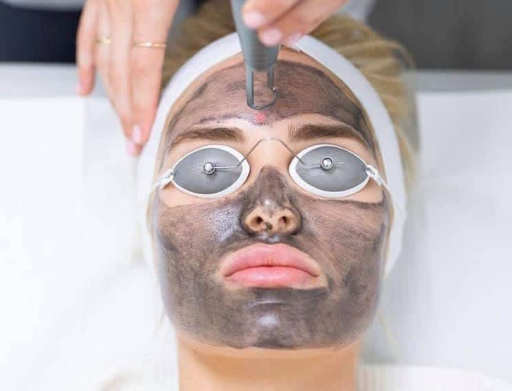 Carbon laser facial