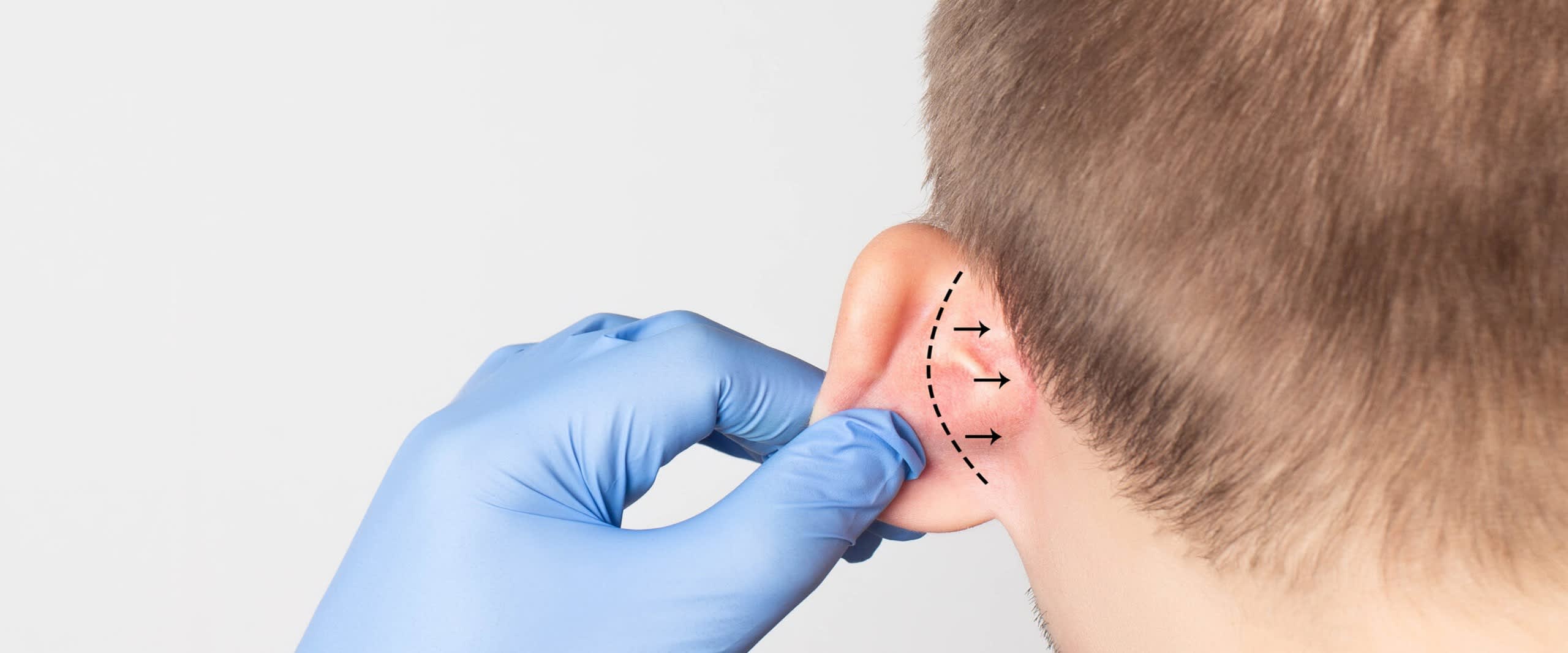 Ear correction / otoplasty
