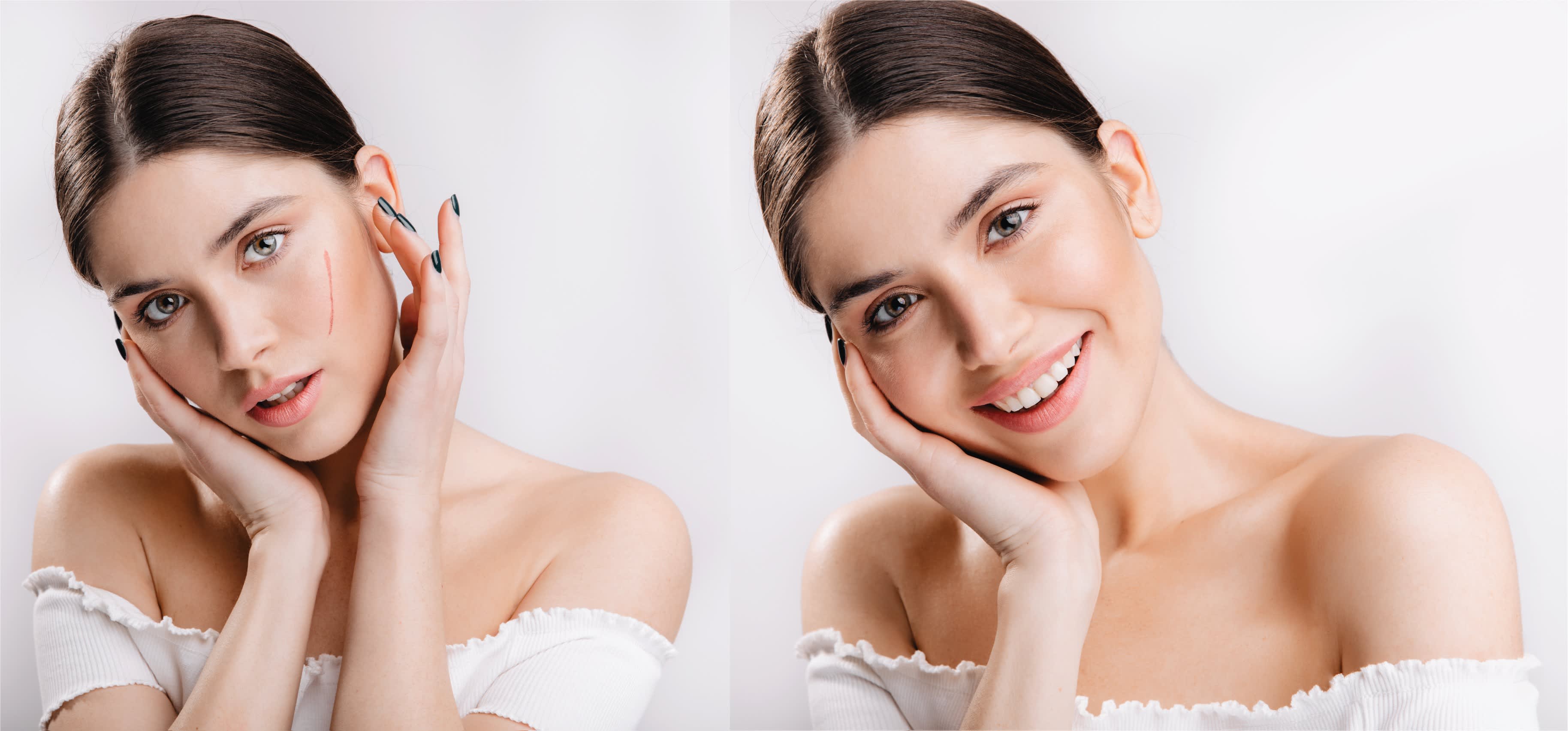 Scar revision before and after — facial scar