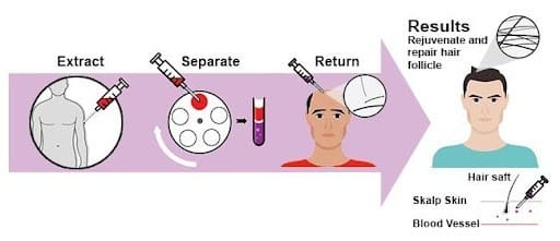 Best hair transplant in Bathinda — before and after results