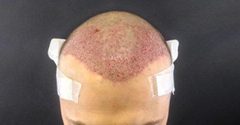 Hair transplant surgery