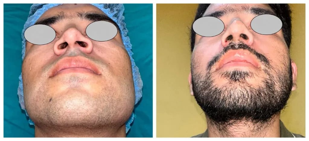 Facial asymmetry correction with rhinoplasty — worm’s-eye view