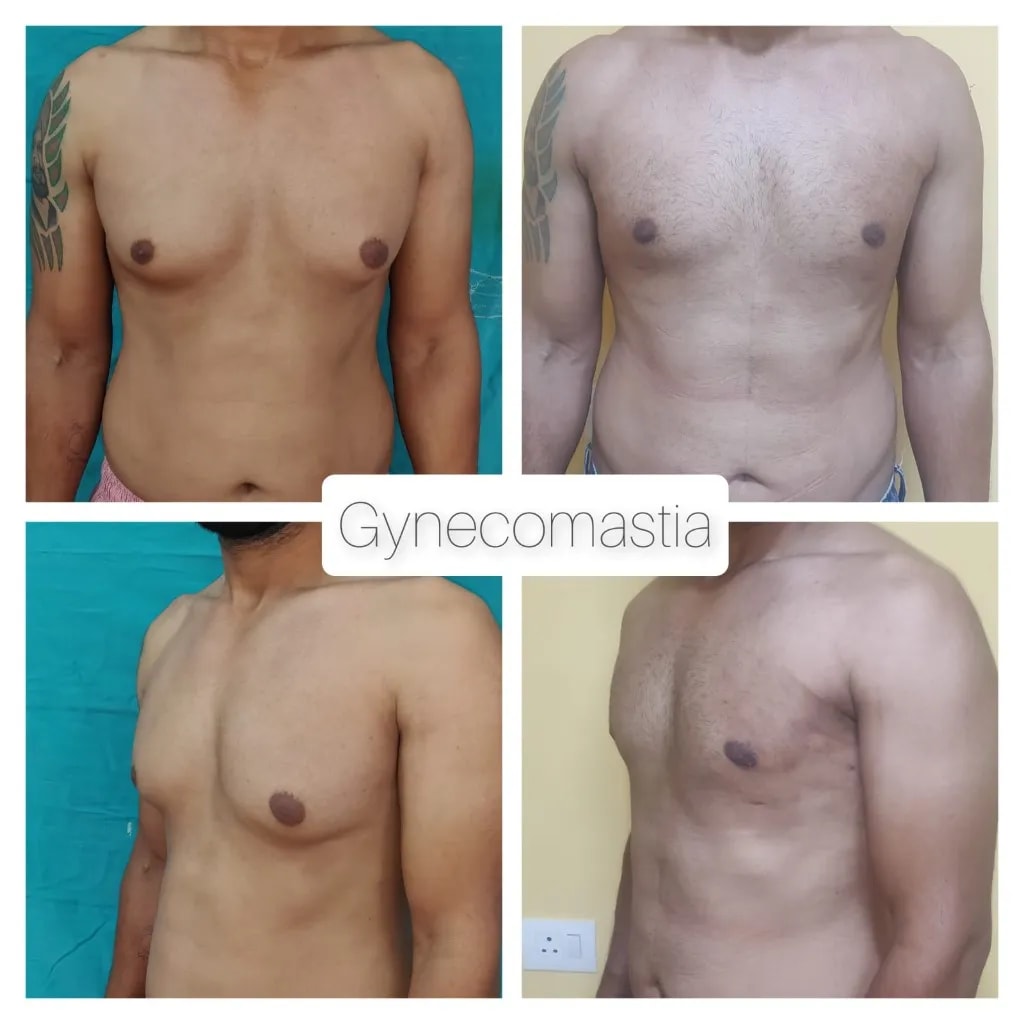 Gynecomastia before and after — four-panel front and side comparison