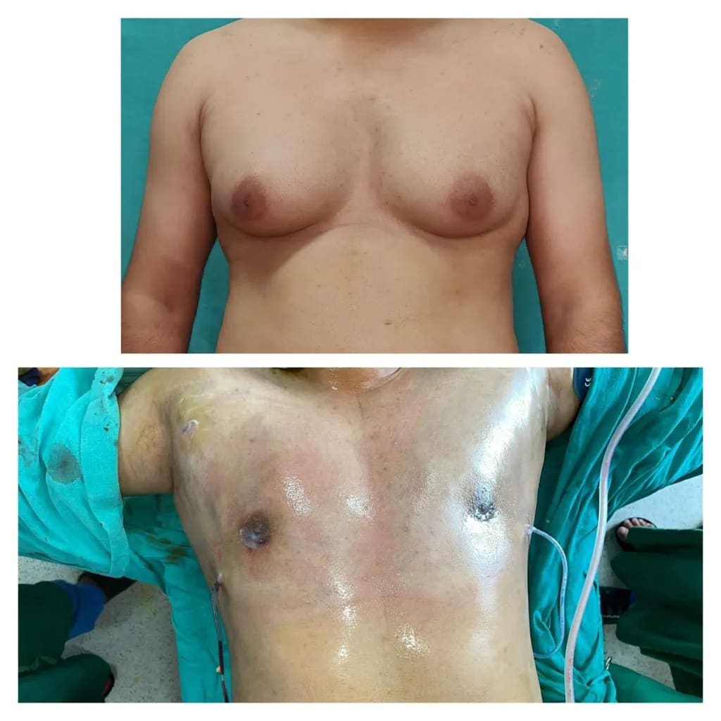 Gynecomastia before and after — early post-operative views