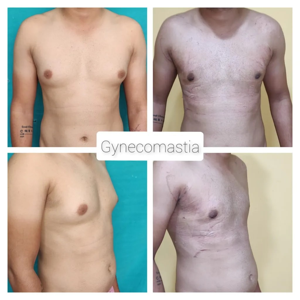 Gynecomastia before and after — four views