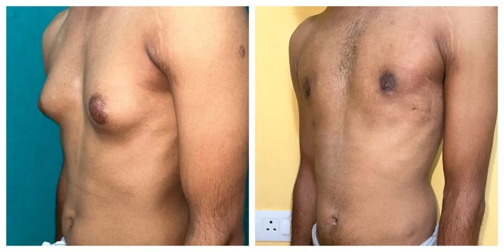 Gynecomastia before and after — side and three-quarter