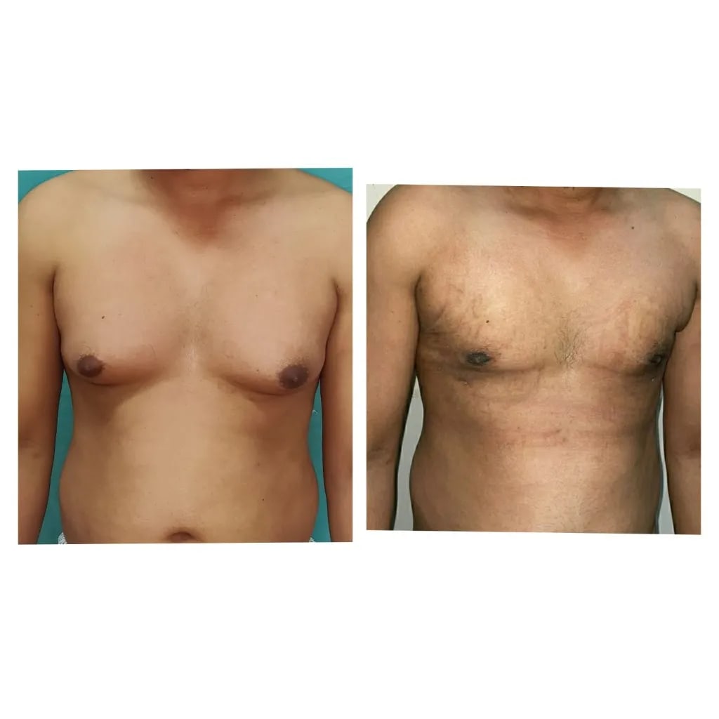 Gynecomastia before and after — front comparison