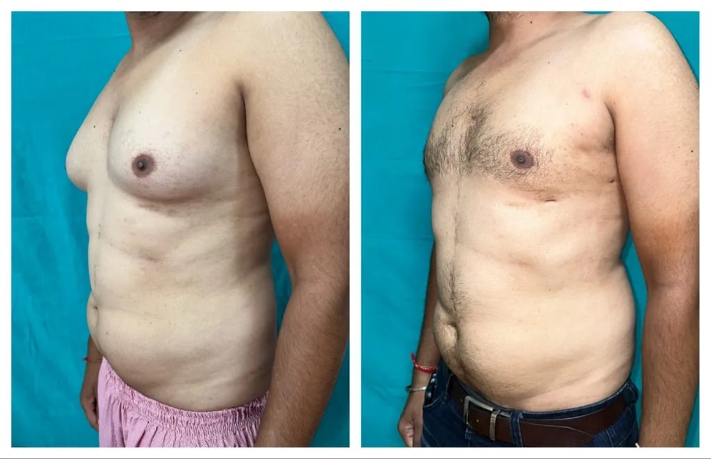 Gynecomastia before and after — side profile