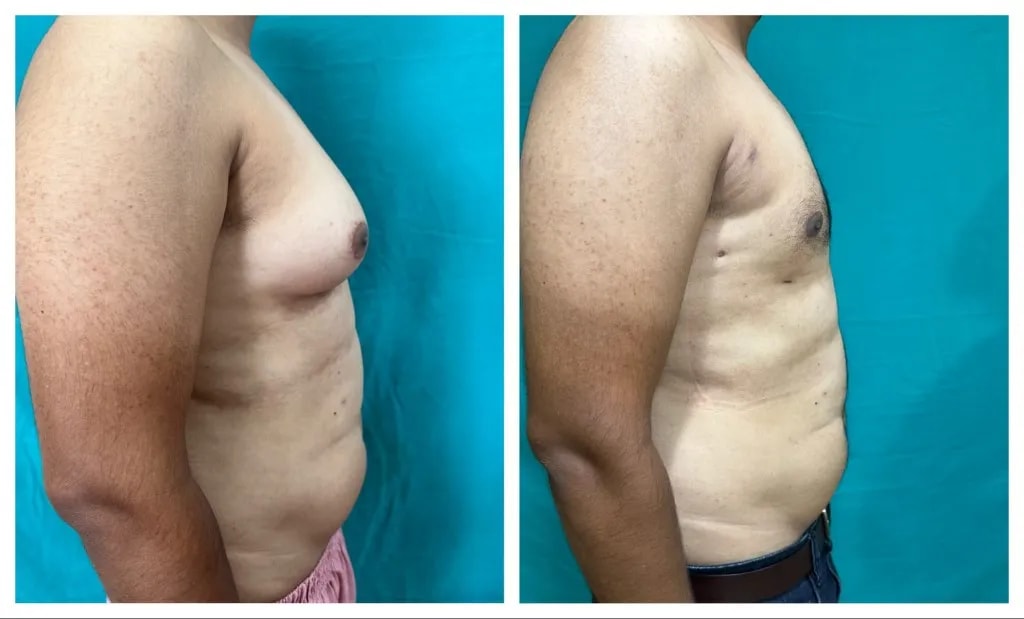 Gynecomastia before and after — side chest contour