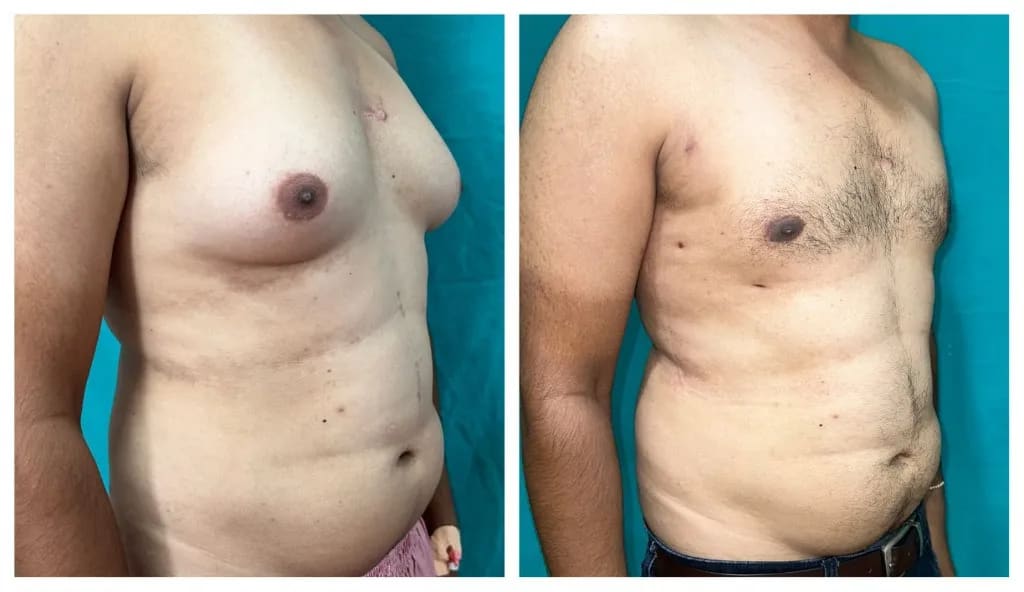 Gynecomastia before and after — three-quarter view