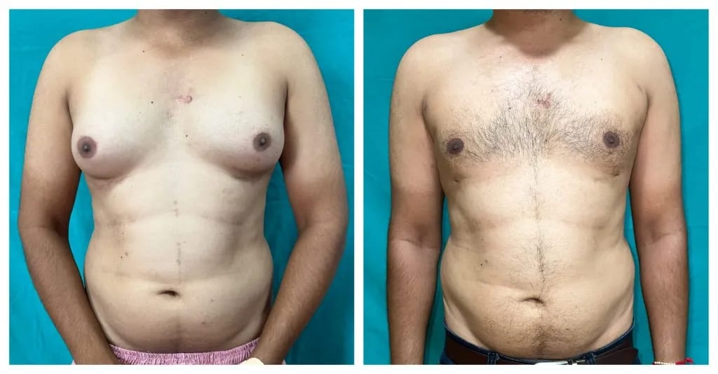 Gynecomastia before and after — frontal view