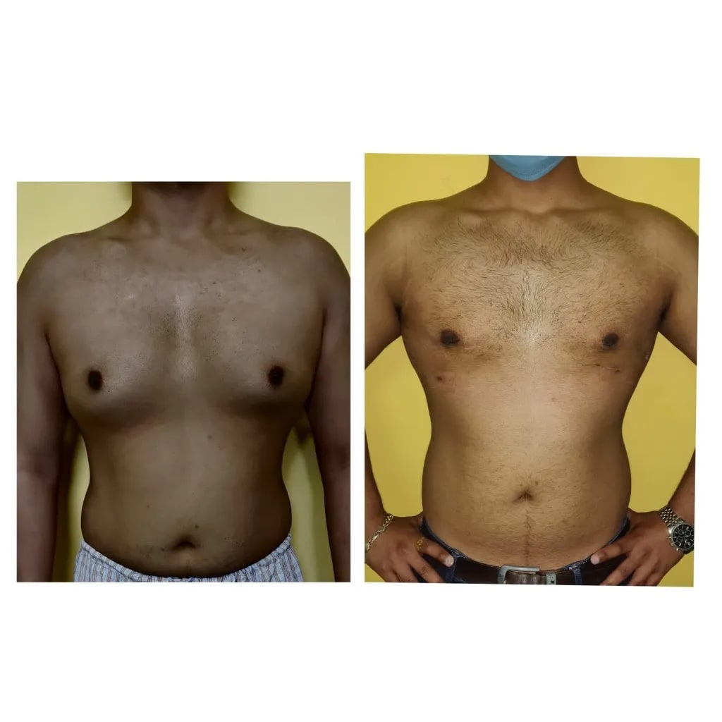 Gynecomastia and body contouring before and after
