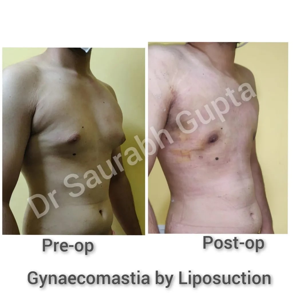 Gynaecomastia by liposuction — pre-op and post-op