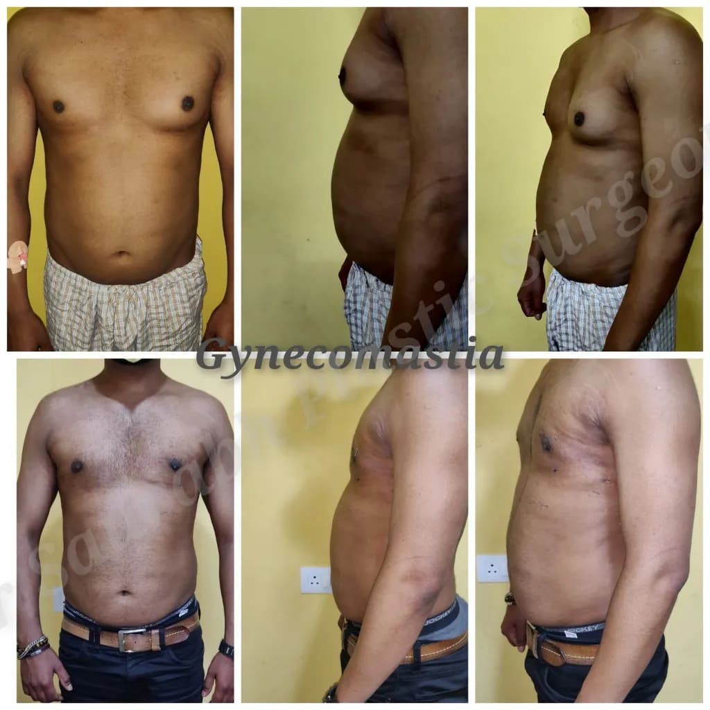 Gynecomastia real patient result