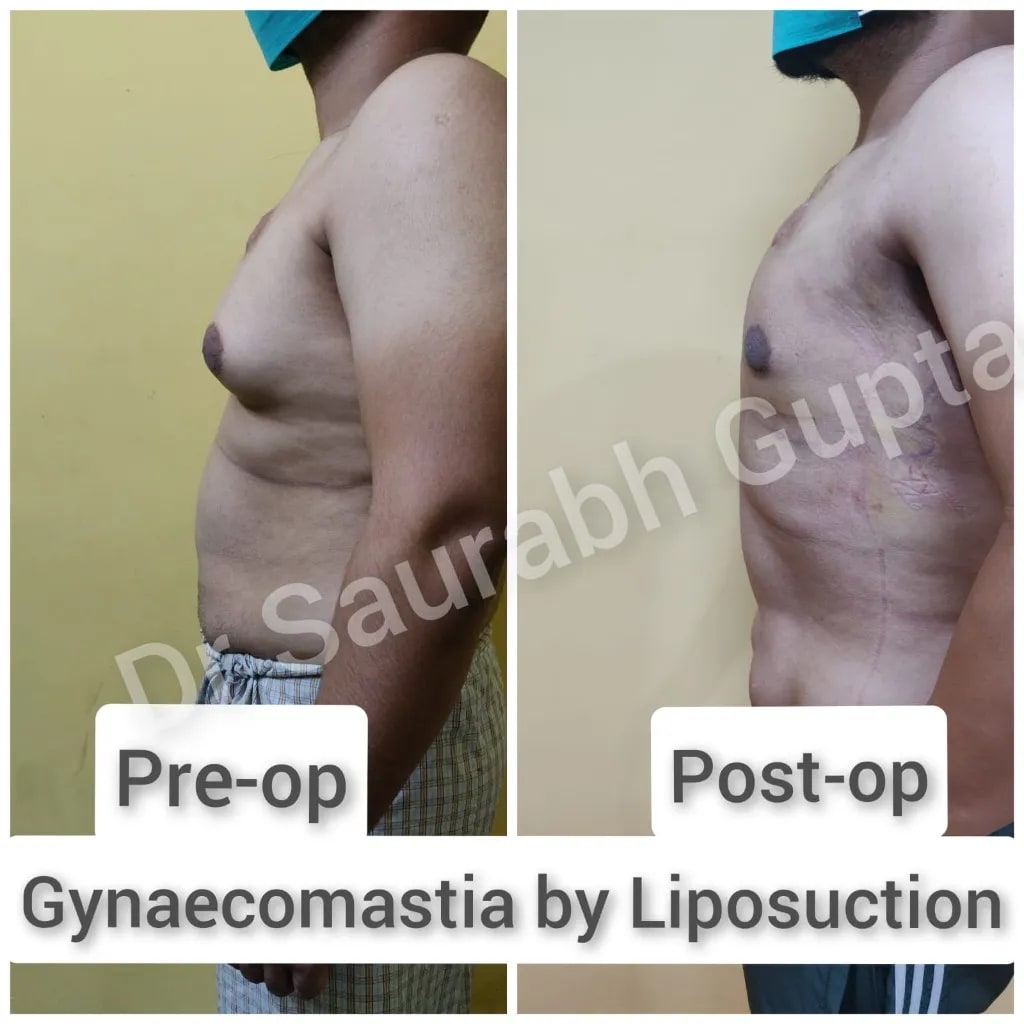 Gynaecomastia by liposuction — labelled pre-op and post-op