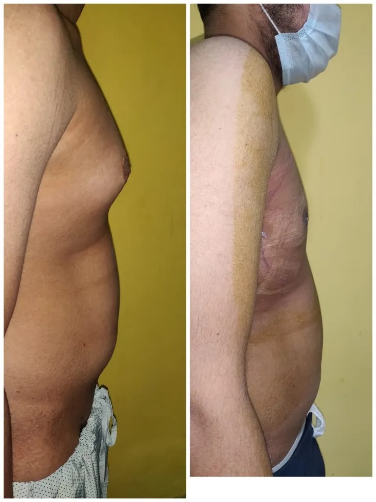 Gynecomastia before and after — side profile