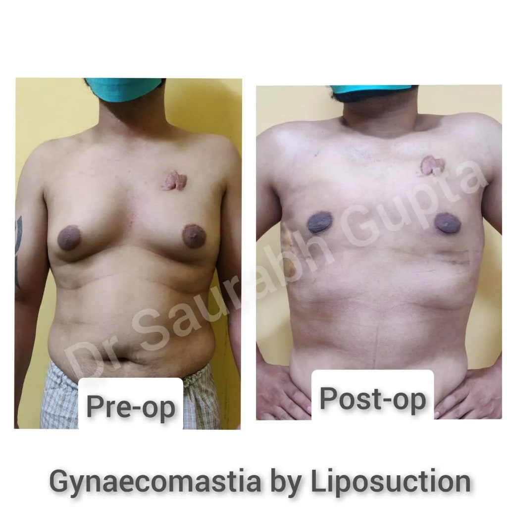 Gynaecomastia by liposuction — pre-op and post-op