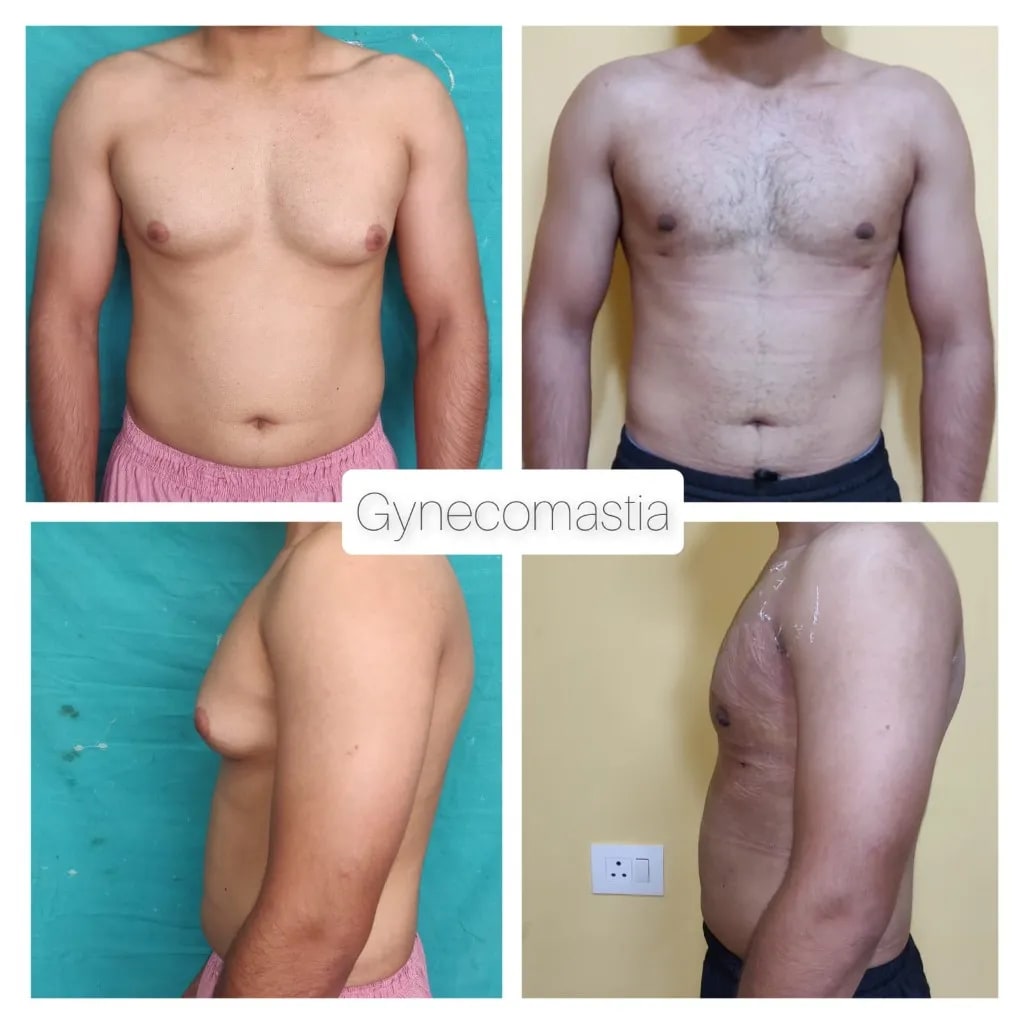 Gynecomastia before and after — front and side collage