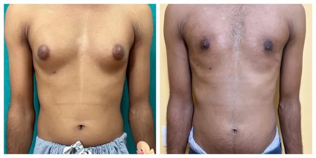 Gynecomastia before and after — frontal chest contour