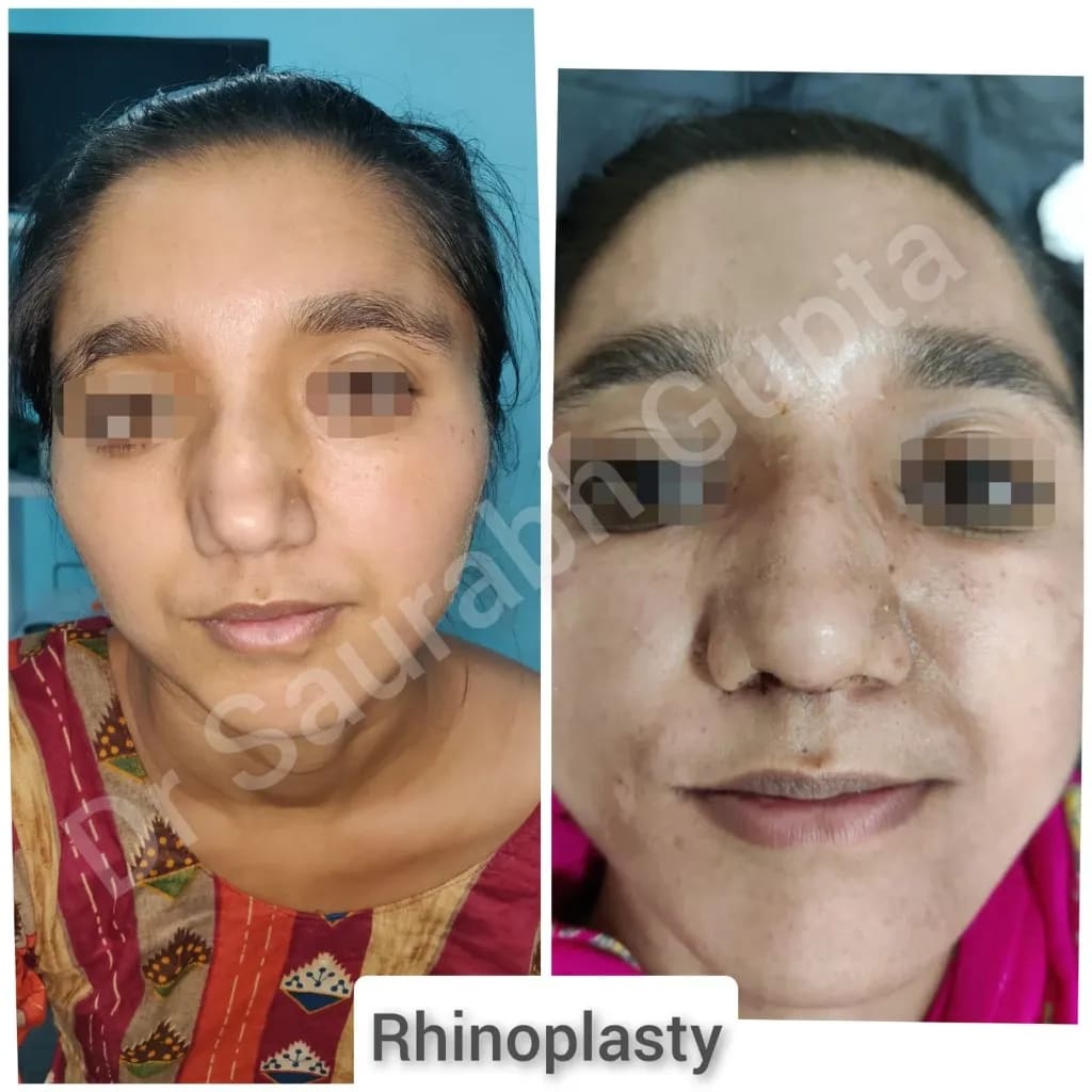 Rhinoplasty before and after — female front view