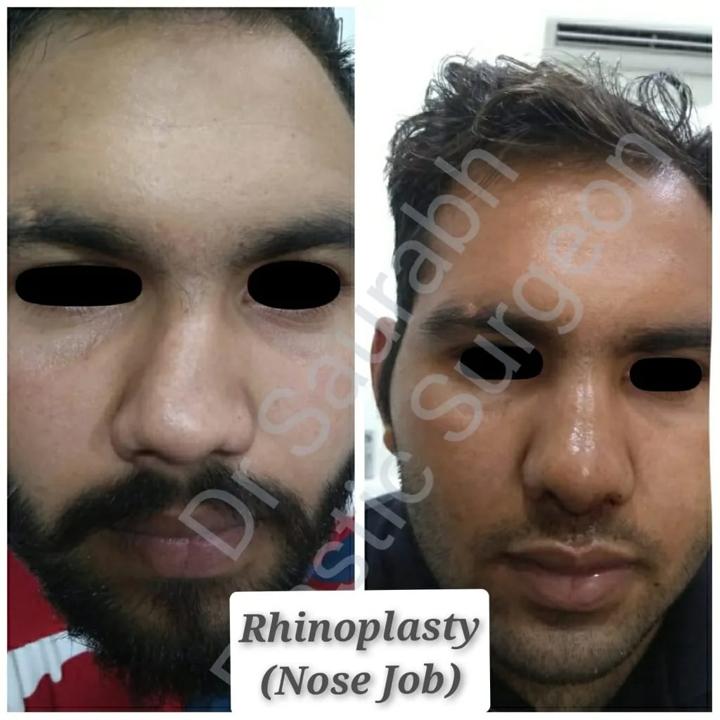 Rhinoplasty before and after — male nose job
