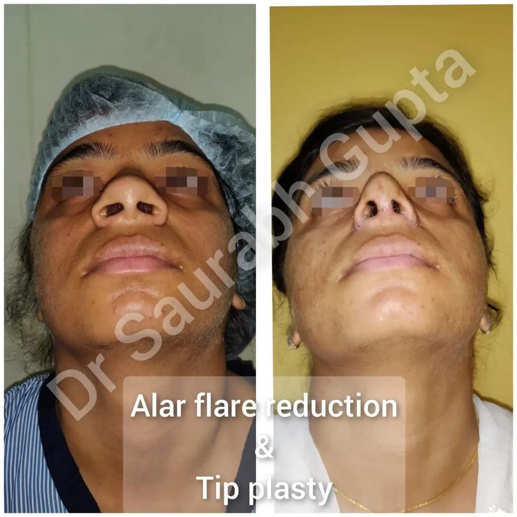 Rhinoplasty — alar flare reduction and tip plasty
