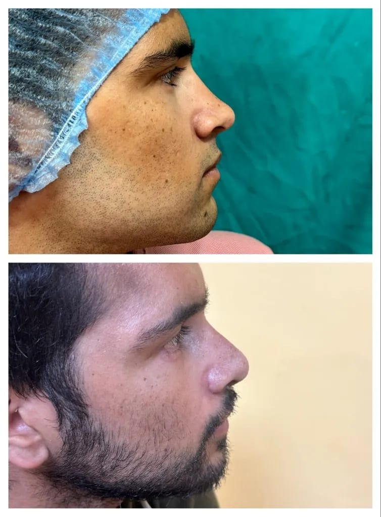 Rhinoplasty before and after — male profile