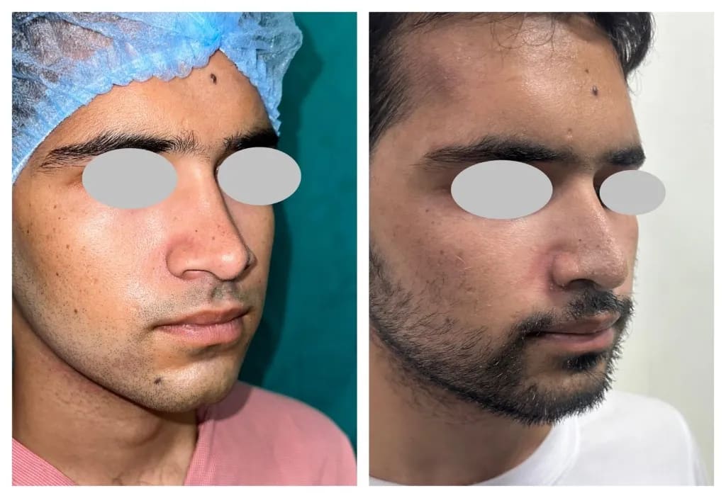Rhinoplasty real patient result