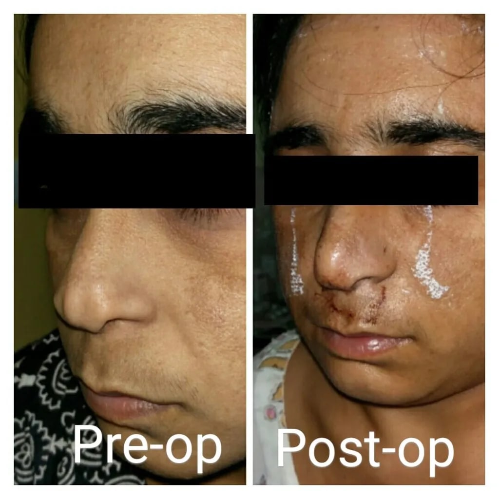 Rhinoplasty pre-op and early post-op
