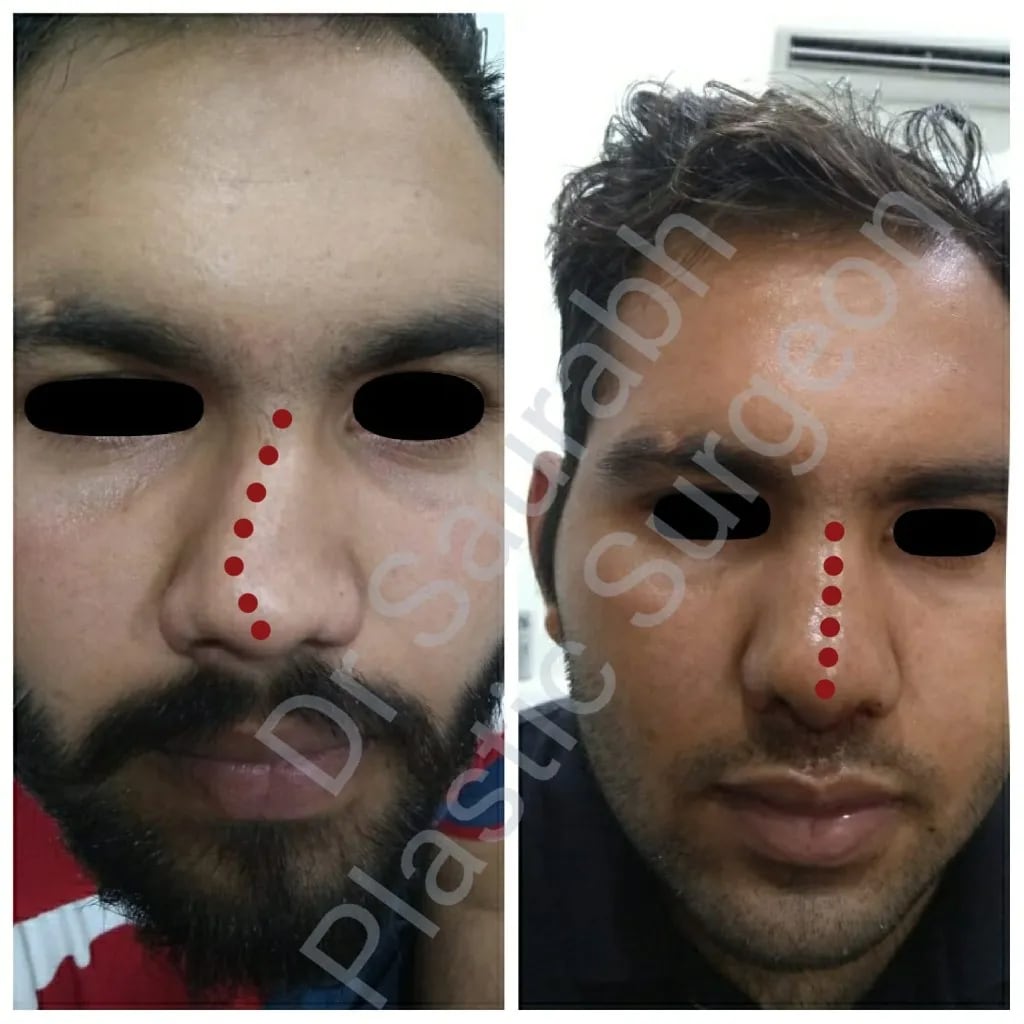 Crooked nose rhinoplasty — before and after