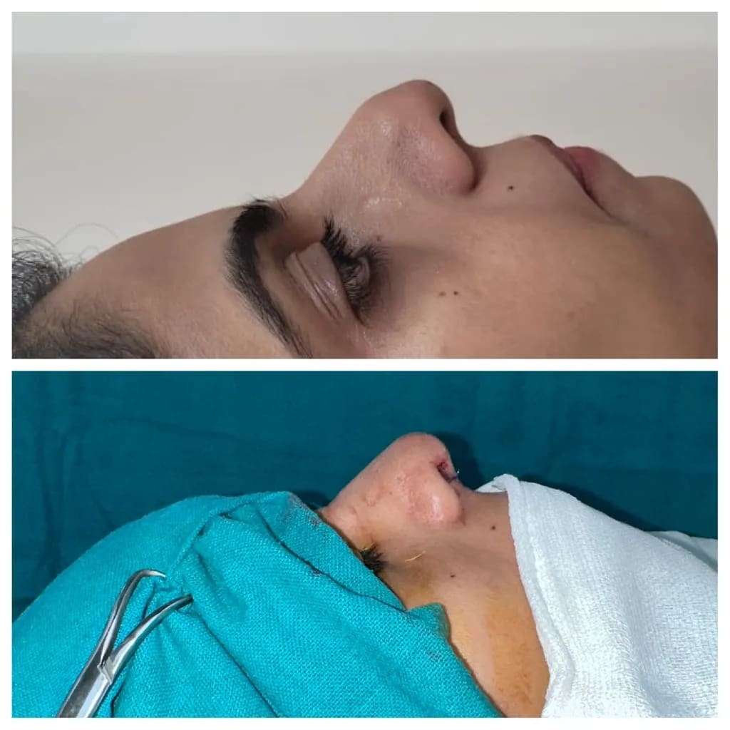 Rhinoplasty before and after — female profile, dorsal hump
