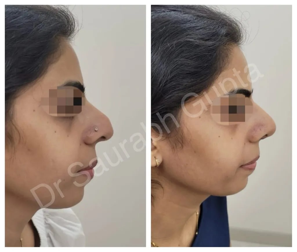 Rhinoplasty before and after — female profile split