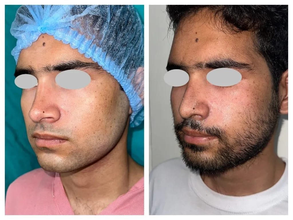 Rhinoplasty before and after — male front view