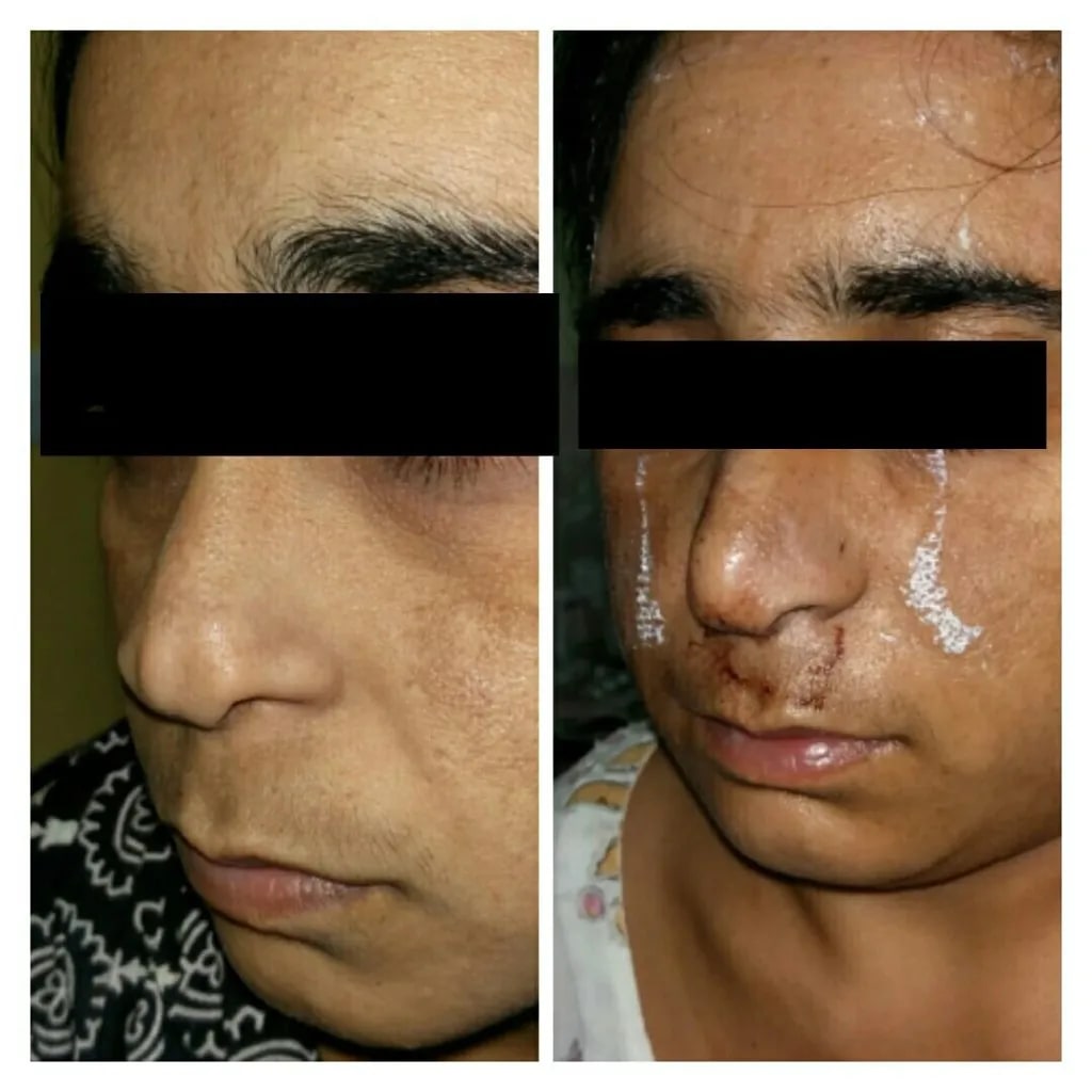 Rhinoplasty before and after — three-quarter view