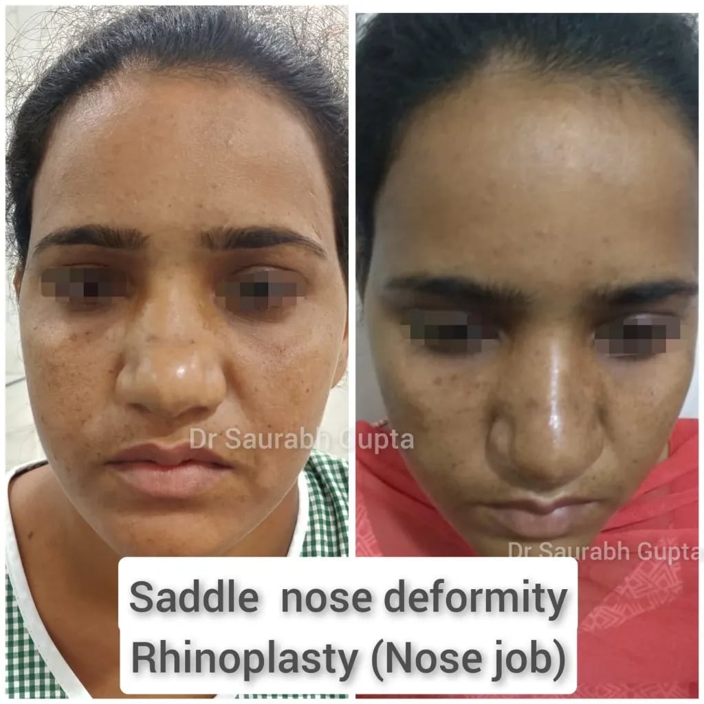Saddle nose deformity rhinoplasty — before and after