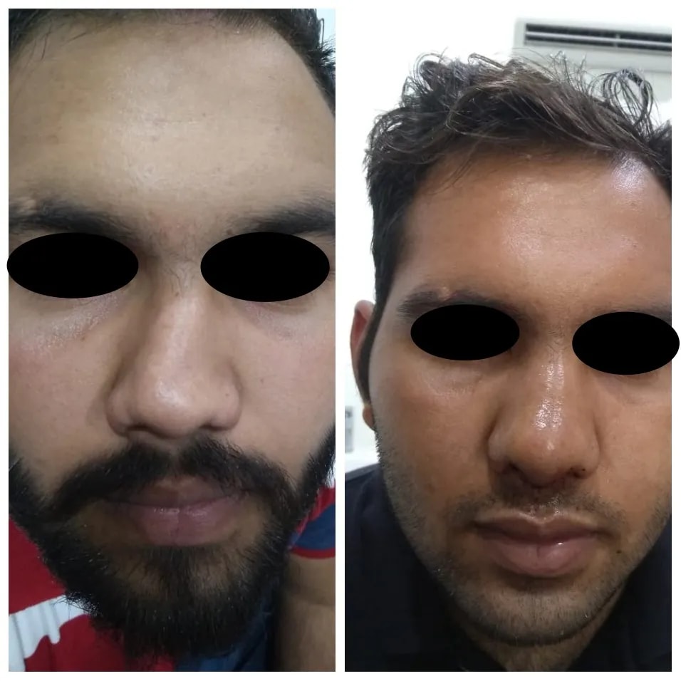 Rhinoplasty before and after — front view, tip refinement