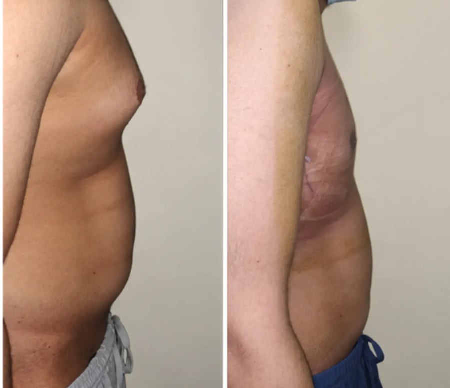 Gynaecomastia surgery before and after — side profile, case 1 at Revive61 Faridabad
